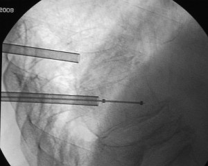 Visione laterale della colonna lombare: Dopo introduzione delle camere di lavoro in due vertebre lombari adiacenti deformate per fratture su osteoporosi si introduce il palloncino sgonfio. Visione laterale della colonna lombare: Dopo introduzione delle camere di lavoro in due vertebre lombari adiacenti deformate per fratture su osteoporosi si introduce il palloncino sgonfio.
