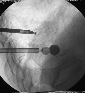 Mentre il palloncino viene gonfiato per creare l’alloggio per il cemento nella vertebra più caudale, nella vertebra soprastante, che appare schiacciatissima, si introduce una particolare courette che si angola fino a 90° per creare uno spazio per il cemento. In questa vertebra il palloncino determinerebbe una rottura dei piatti superiore e inferiore con fuoriuscita del cemento verso i dischi e quindi, a mio parere, è controindicato. Mentre il palloncino viene gonfiato per creare l’alloggio per il cemento nella vertebra più caudale, nella vertebra soprastante, che appare schiacciatissima, si introduce una particolare courette che si angola fino a 90° per creare uno spazio per il cemento. In questa vertebra il palloncino determinerebbe una rottura dei piatti superiore e inferiore con fuoriuscita del cemento verso i dischi e quindi, a mio parere, è controindicato.