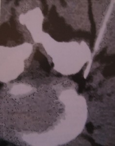 Visione TAC assiale di una vertebra lombare. Si evidenzia una ago introdotto in sede intraforaminale per l’iniezione di una miscela di ossigeno-ozono (nero) per la cura di una sciatica da sofferenza radicolare. Visione TAC assiale di una vertebra lombare: Si evidenzia una ago introdotto in sede intraforaminale per l’iniezione di una miscela di<br />
ossigeno-ozono (nero) per la cura di una sciatica da sofferenza radicolare.